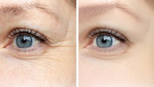 درمان خطوط چشم با چند روش ساده