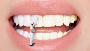 محافظت از دندان با جرم گیری به موقع