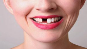 معایب فاصله بین دندان
