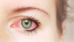 عوامل موثر در حساسیت چشم به لوازم آرایش